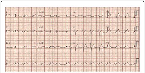 mild left ventricular hypokinesis.